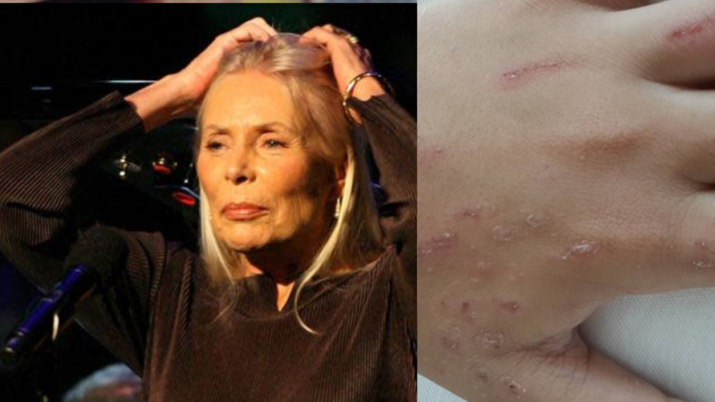 Joni Mitchell health